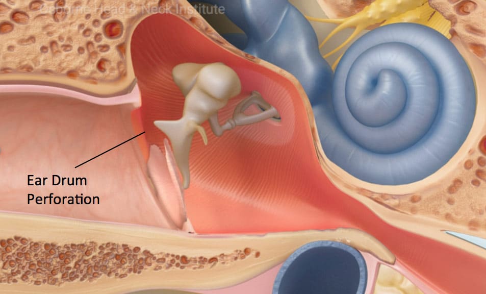 Medium perforations (15-35% of ear drum)