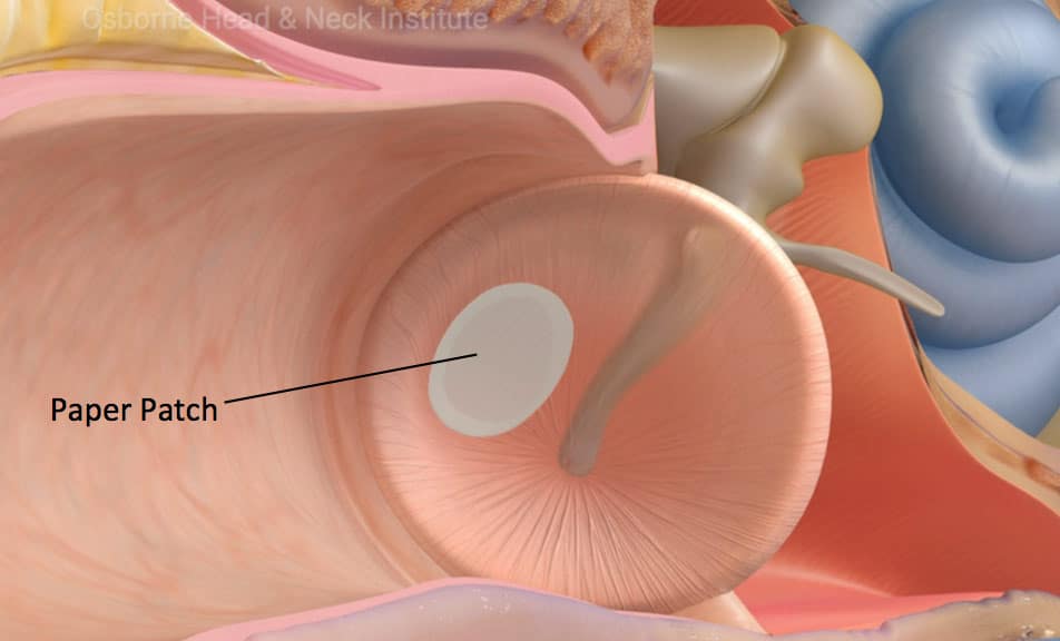 Small perforations (1-15% of ear drum)