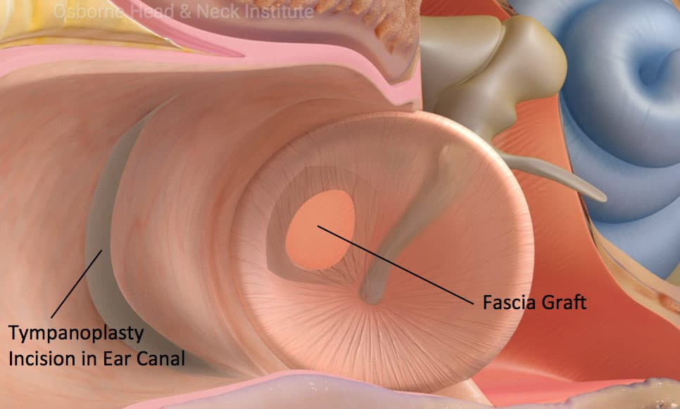 Large perforation  (35%-100% of ear drum)