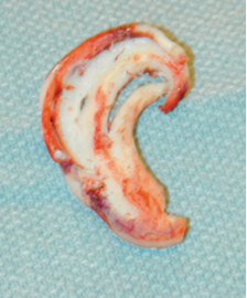Harvested and molded rib cartilage ready for subcutaneous placement